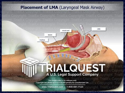 Placement of LMA (Laryngeal Mask Airway) - TrialQuest Inc.