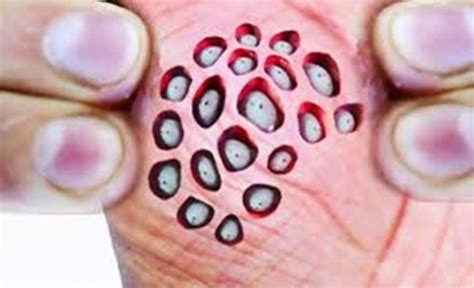 Lotus Pod Holes In Skin