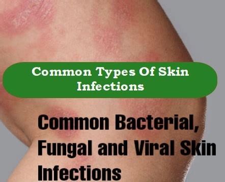 Bacterial, Fungal & Viral Skin Infections: Common Signs & Symptoms, Types, Causes, Treatment ...