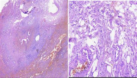 Tissue section showing extensive peribronchial inflammatory infiltrates. | Download Scientific ...