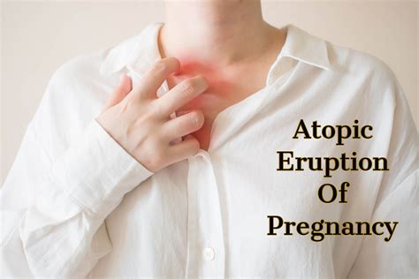 Atopic Eruption Of Pregnancy- Causes, Symptoms and Treatment - Being ...