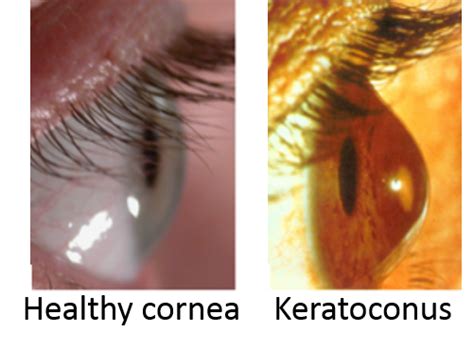 Keratoconus - Dr.Thind