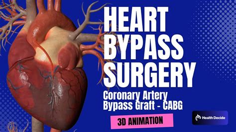 How Heart Bypass Surgery Works (Coronary Artery Bypass Graft CABG) - 3D ...