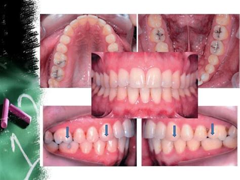 Lower incisor extraction in Orthodontics