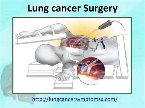 Lung cancer surgery | PPT