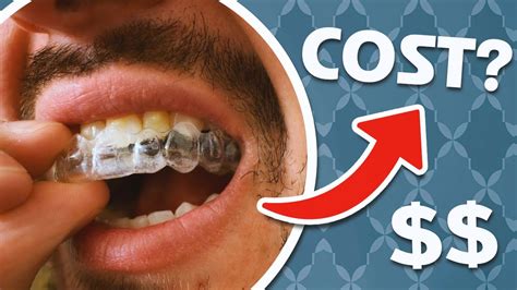 How Much Do Retainers Cost? (And When Should They Be Replaced) - YouTube