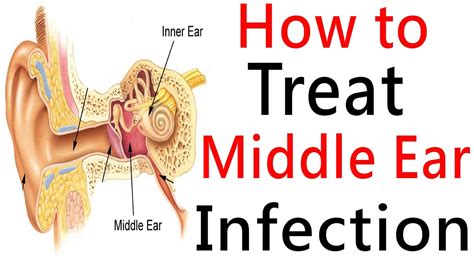 Middle Ear Infection & Middle Ear Effusion - Causes & Treatment