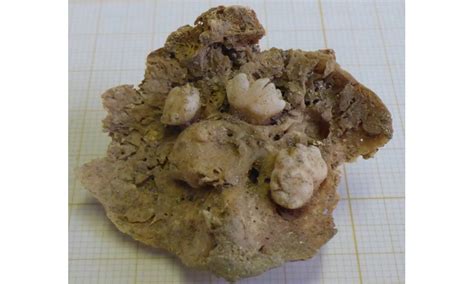 Ovarian teratoma with teeth discovered in remains of 15th century woman