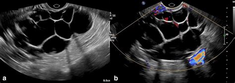 Theca-lutein cysts. a Gray scale transvaginal images of the left ovary... | Download Scientific ...