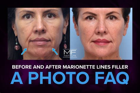 Before and After Marionette Lines Filler: A Photo FAQ | Mabrie Facial ...