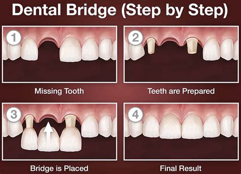 Dental Bridge - Procedure, Dental Bridge Vs Dental Implant