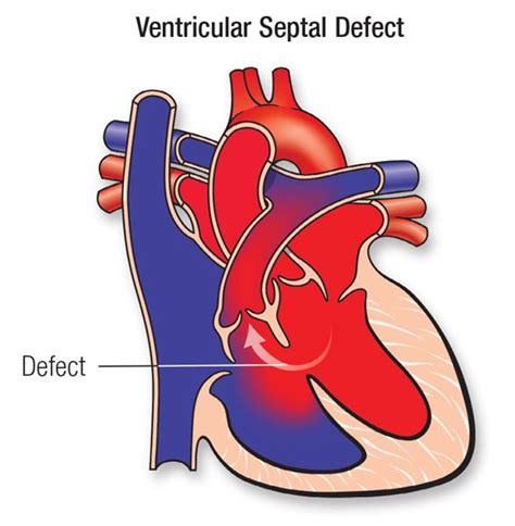 Ventricular Septal Defect (VSD) | American Heart Association