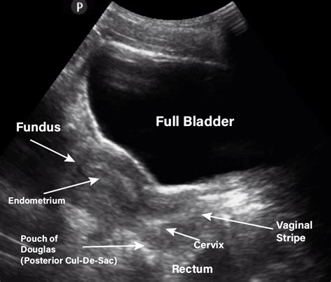 What Is A Pelvic Ultrasound