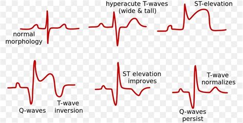 ST Elevation Acute Myocardial Infarction ST Segment Elevation ...