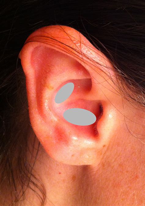 Ear cartilages