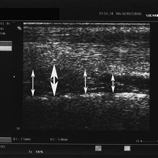 -Color Doppler ultrasound image taken 4 years after the onset of the... | Download Scientific ...