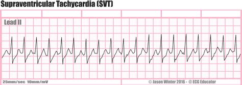 ECG Educator Blog : Supraventricular Tachycardia (SVT)