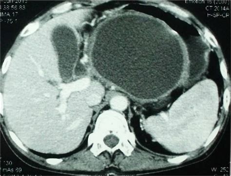 Cureus | Valproic Acid-Induced Severe Acute Pancreatitis with Pseudocyst Formation: Report of a Case