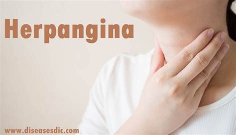 Herpangina – Symptoms, Complications and Treatment