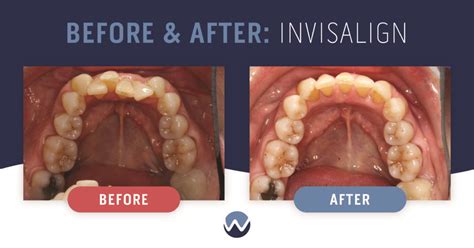 Clear Aligners Before & After: See How They Transform Smiles • Woodhill ...