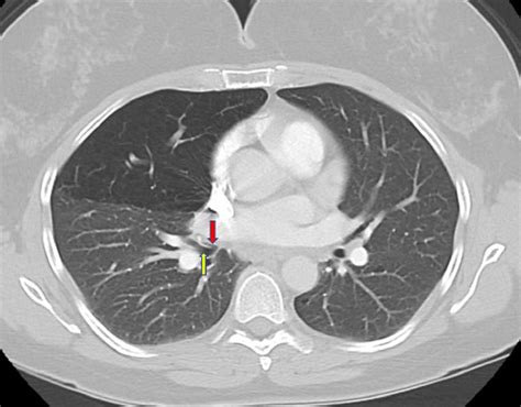 Axial CT scan showing atretic and narrow airway leading to the medial ...