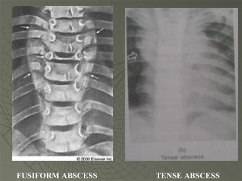 Tuberculosis of spine and its complications nishanth