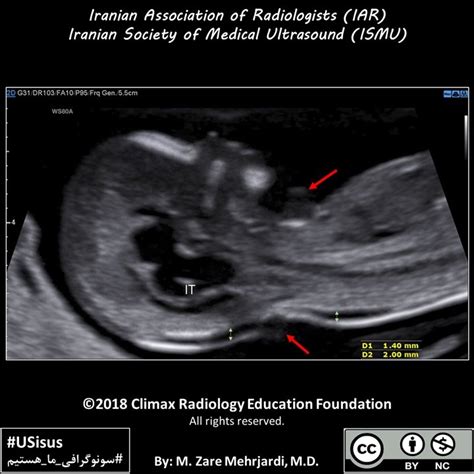 (PDF) Nuchal cord during measurement of nuchal translucency