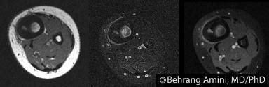 Roentgen Ray Reader: Osteoid Osteoma: MRI Appearance