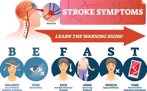 Stroke - "BEFAST" - High Peak First Aid