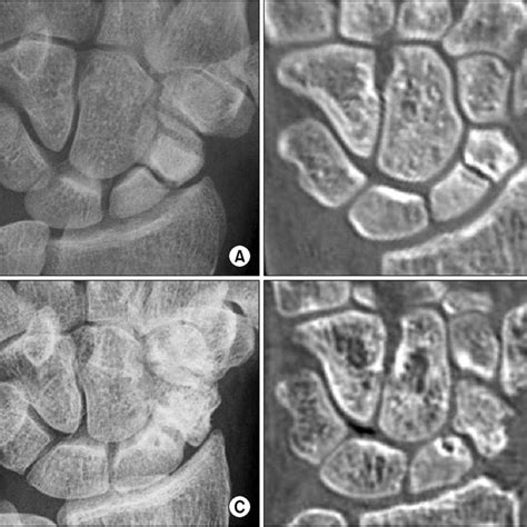 DISI Deformity, Fragment Ratio, and C-T Distance of Type I or II Lunate... | Download Table