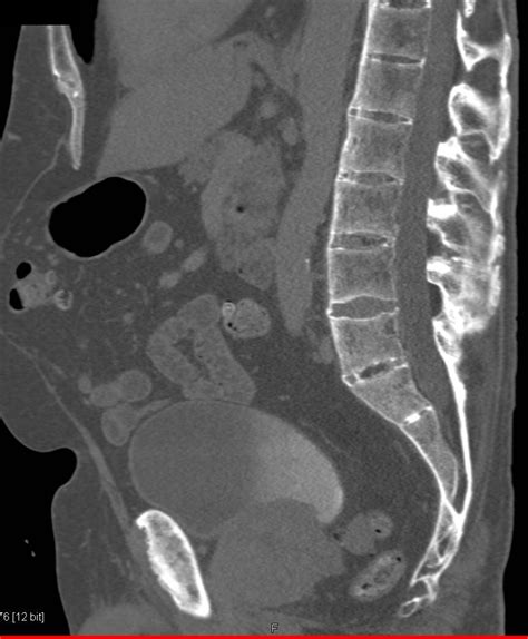 Ankylosing Spondylitis Mri Si Joint