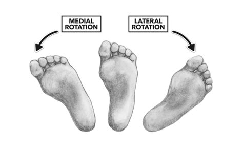 Inversion Of The Foot - cloudshareinfo