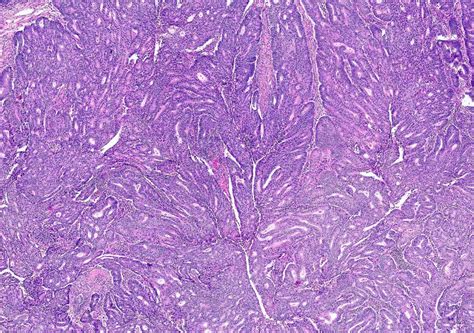 Pathology Outlines - Endometrioid carcinoma