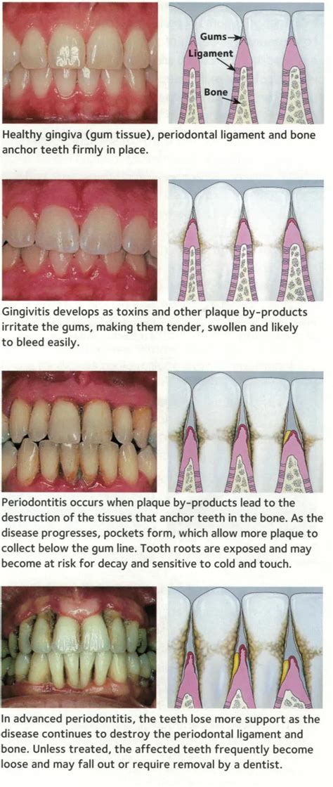 Healthy Gums vs. Unhealthy Gums – Oral and Overall Health