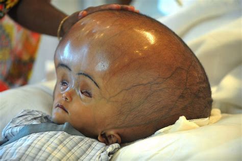 Swollen-head Baby: Parents Of Roona Begum Plead For More Financial Aid As Treatment Continues ...