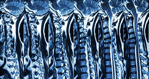 Cervical spondylosis with disc herniation ( MRI of cervical spine ...