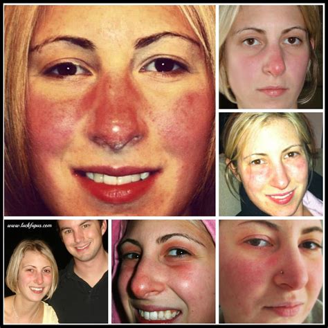 “Cover up with makeup in the mirror…” | Lupus butterfly rash, Makeup ...