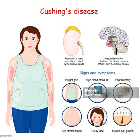 Cushings Disease Signs And Symptoms Of Cushing Syndrome Stock Illustration - Download Image Now ...