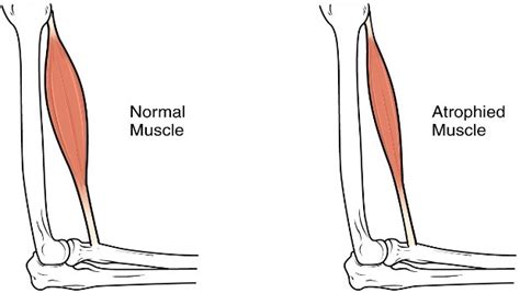 Muscle weakness diseases, disorders and treatment – VKool.com