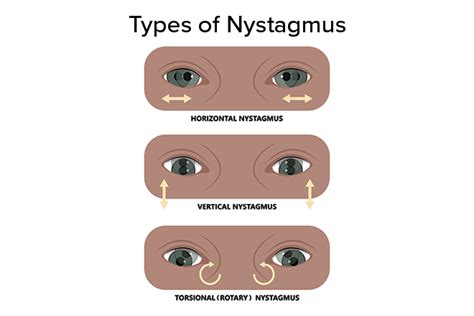 Nystagmus Types - All About Vision