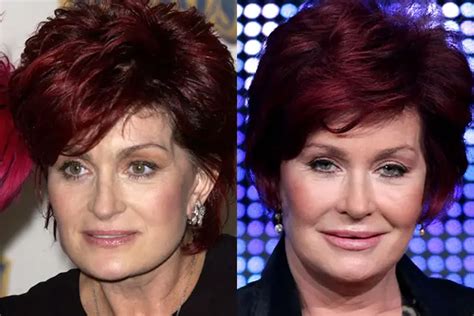 Sharon Osbourne Facelift Plastic Surgery Before and After | Celebie