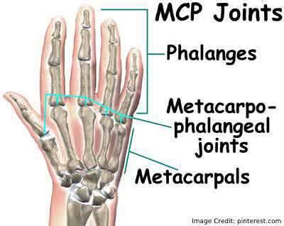 What You Should Know About Metacarpophalangeal Joint Pain?