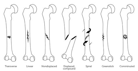 Fracture in the family - Body Organics