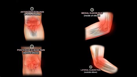 Elbow Pain: Causes and Treatment — OrthopaedicPrinciples.com