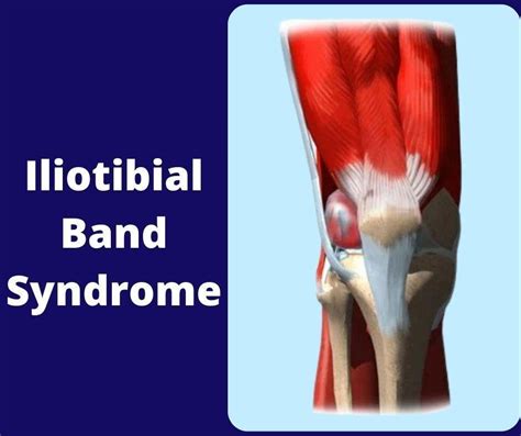 Iliotibial Band Syndrome | The Prolotherapy Clinic