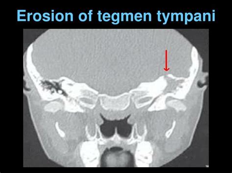 PPT - Complications of Suppurative Otitis Media PowerPoint Presentation - ID:226262