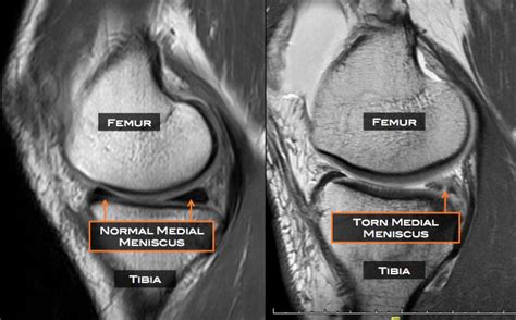 Meniscus Anatomy Mri