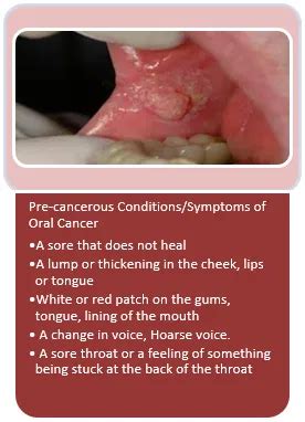 Signs Of Oral Cancer On Tongue