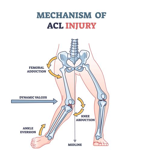 ACL Injury Calgary — Precision Performance & Wellness - Calgary Chiropractor