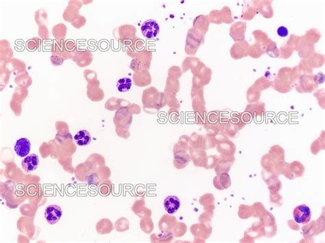 Photograph | Blood smear, pernicious anemia, LM | Science Source Images